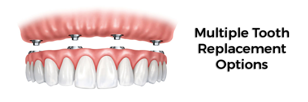 Santa Ana Multiple Teeth Replacement Options