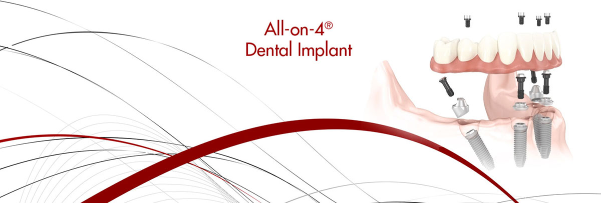 Santa Ana All-on-4 Dental Implants