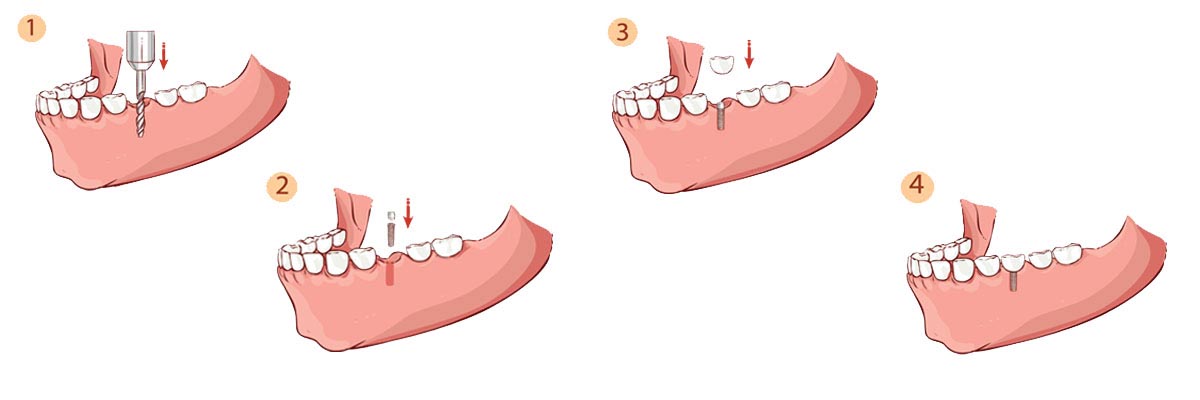 Santa Ana The Dental Implant Procedure