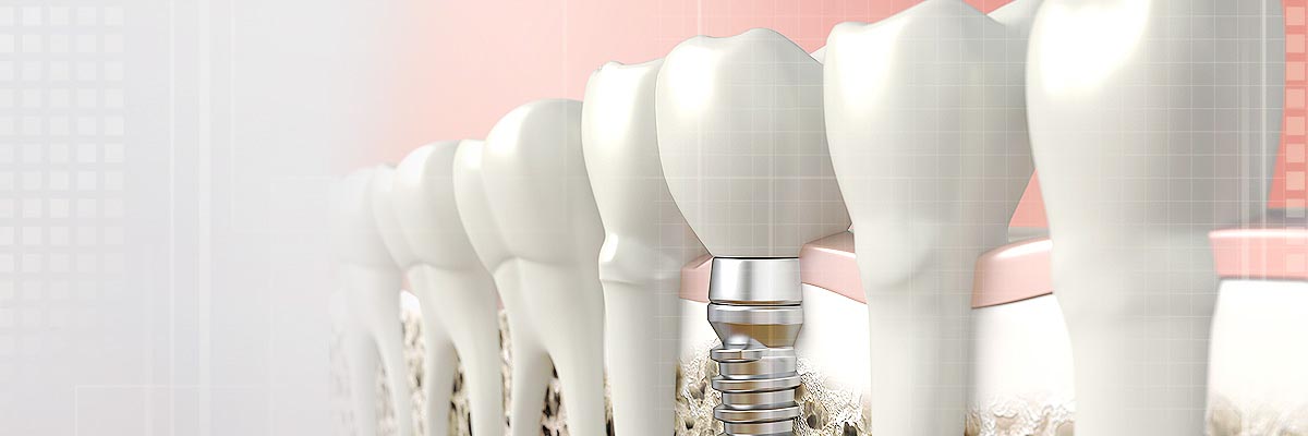 Santa Ana Implant Dentist