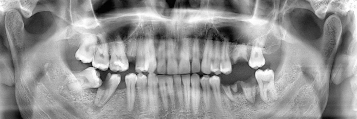 Santa Ana Options for Replacing Missing Teeth